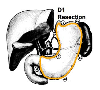 D1 resection